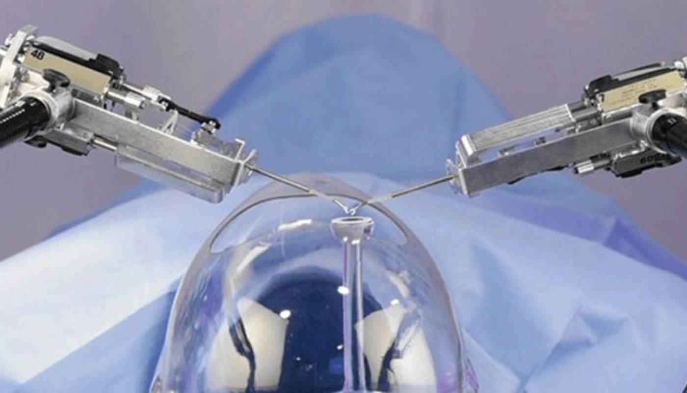 Robotic AI Cataract Surgery in Chandigarh